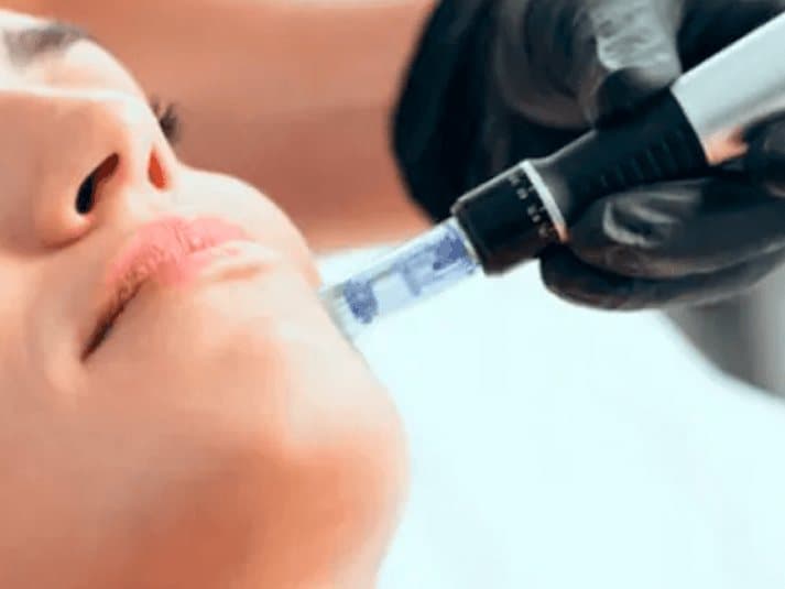 Tratamiento con Dermapen en el rostro