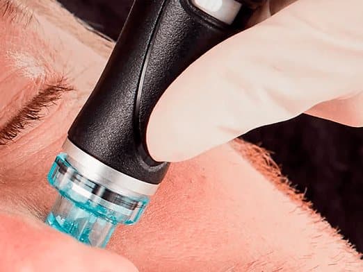 Punta de Hydrafacial sobre la piel