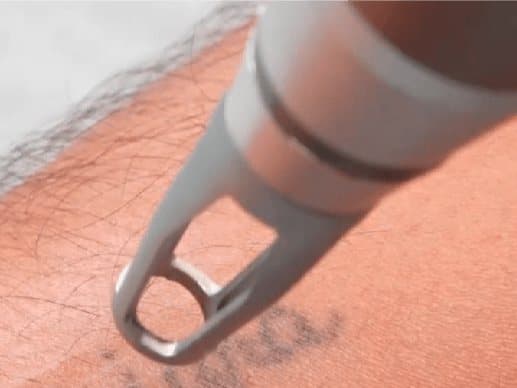 Láser Lásertech sobre un tatuaje en el brazo
