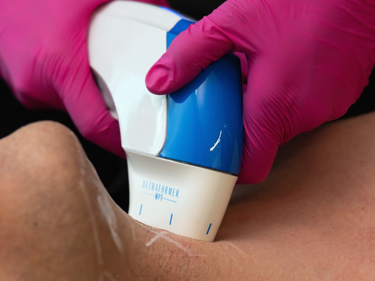 Tratamiento con Ultraformer MPT en el cuello